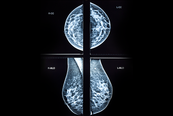 Mammographie der Brust